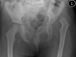 Developmental Dysplasia of the Hip