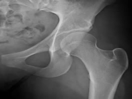 Young Adult Hip Disorders