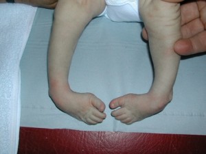 newborn child with clubfoot