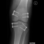 leg length difference treated with epiphysiodesis