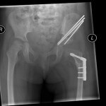 Child with dislocated hip