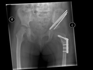 after open reduction, femoral osteotomy and pelvic osteotomy