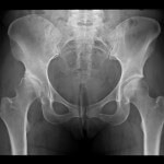 Triple pelvic osteotomy
