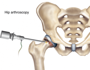 diagram of hip arthroscopy